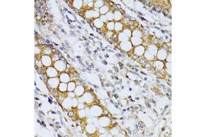 Immunohistochemistry of paraffin-embedded human colon using CCDC92 antibody (ABIN5974817) at dilution of 1/100 (40x lens).