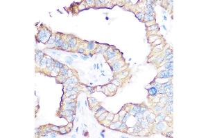 Immunohistochemistry of paraffin-embedded human liver cancer using CD47 antibody (ABIN6127604, ABIN6138199, ABIN6138201 and ABIN6223104) at dilution of 1:100 (40x lens). (CD47 anticorps  (AA 20-140))