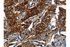 The image on the left is immunohistochemistry of paraffin-embedded Human lung cancer tissue using ABIN7189591(ABCC5 Antibody) at dilution 1/50, on the right is treated with synthetic peptide. (ABCC5 anticorps)