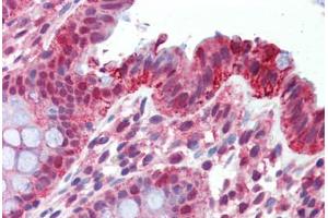 Human Colon (formalin-fixed, paraffin-embedded) stained with ITGA6 antibody ABIN462312 followed by biotinylated goat anti-rabbit IgG secondary antibody ABIN481713, alkaline phosphatase-streptavidin and chromogen.