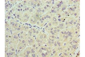 Immunohistochemistry of paraffin-embedded human liver cancer using ABIN7171285 at dilution of 1:100 (TRBC1 anticorps  (AA 1-176))