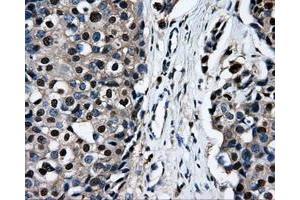 Immunohistochemical staining of paraffin-embedded Adenocarcinoma of ovary tissue using anti-RALBP1mouse monoclonal antibody. (RALBP1 anticorps)