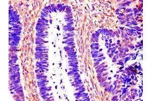 Immunohistochemistry of paraffin-embedded human ovarian cancer using ABIN7146996 at dilution of 1:100