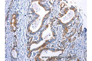 Immunohistochemistry of Human gastric cancer using DRD4 Polyclonal Antibody at dilution of 1:30