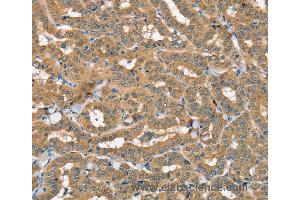 Immunohistochemistry of Human thyroid cancer using SEC14L2 Polyclonal Antibody at dilution of 1:40 (SEC14L2 anticorps)
