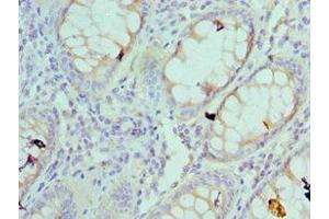 Immunohistochemistry of paraffin-embedded human colon cancer using ABIN7142558 at dilution of 1:100 (RPS4X anticorps  (AA 66-263))
