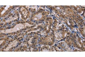 Immunohistochemistry of paraffin-embedded Human thyroid cancer using CUL3 Polyclonal Antibody at dilution of 1:30 (Cullin 3 anticorps)