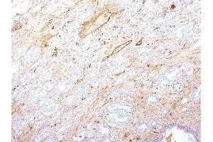 Formalin-fixed, paraffin-embedded human Pancreatic Adenocarcinoma stained with Fibronectin Monoclonal Antibody (SPM246). (Fibronectin 1 anticorps)