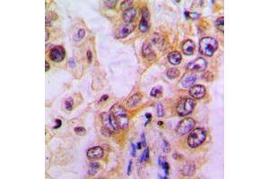 Immunohistochemical analysis of EHHADH staining in human liver cancer formalin fixed paraffin embedded tissue section.