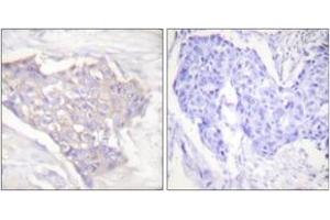 Immunohistochemistry analysis of paraffin-embedded human breast carcinoma tissue, using BIM Antibody. (BIM anticorps  (AA 1-50))