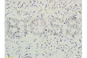 Formalin-fixed and paraffin embedded human colon carcinoma labeled with Rabbit Anti-gremlin Polyclonal Antibody  at 1:200 followed by conjugation to the secondary antibody and DAB staining. (GREM1 anticorps  (AA 101-184))