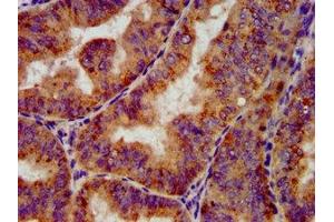 IHC image of ABIN7164068 diluted at 1:100 and staining in paraffin-embedded human endometrial cancer performed on a Leica BondTM system.