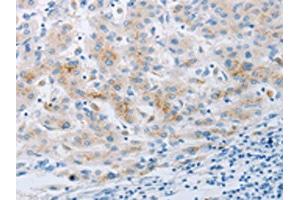 The image on the left is immunohistochemistry of paraffin-embedded Human liver cancer tissue using ABIN7191702(NPY2R Antibody) at dilution 1/20, on the right is treated with synthetic peptide. (NPY2R anticorps)