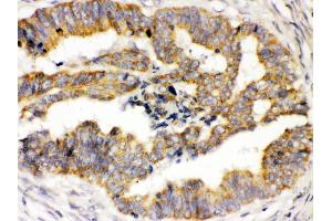 TRPM4 was detected in paraffin-embedded sections of human intestinal cancer tissues using rabbit anti- TRPM4 Antigen Affinity purified polyclonal antibody at 1 μg/mL.