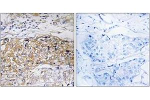 Immunohistochemistry analysis of paraffin-embedded human breast carcinoma tissue, using USP24 Antibody. (USP24 anticorps  (AA 21-70))