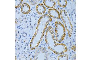 Immunohistochemistry of paraffin-embedded human kidney cancer using MAP2 Antibody. (MAP2 anticorps)