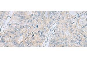 Immunohistochemistry of paraffin-embedded Human colorectal cancer tissue using APOBR Polyclonal Antibody at dilution of 1:35(x200) (APOBR anticorps)