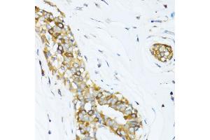 Immunohistochemistry of paraffin-embedded human breast cancer using DCTN2 antibody (ABIN5971226) at dilution of 1/100 (40x lens).