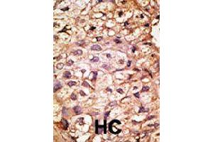 Formalin-fixed and paraffin-embedded human hepatocellular carcinoma tissue reacted with ACE2 polyclonal antibody  , which was peroxidase-conjugated to the secondary antibody, followed by AEC staining. (ACE2 anticorps  (AA 59-90))