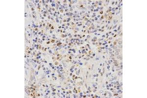 Immunohistochemistry of paraffin-embedded human lung cancer tissue using SCTR antibody at dilution of 1:200 (x400 lens) (SCTR anticorps)