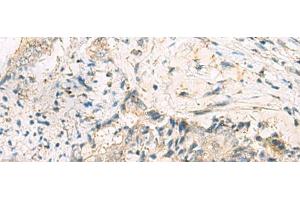 Immunohistochemistry of paraffin-embedded Human cervical cancer tissue using MGAT4B Polyclonal Antibody at dilution of 1:50(x200) (MGAT4B anticorps)