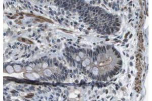 ABIN6266623 at 1/100 staining human colon carcinoma tissue sections by IHC-P. (Peripherin anticorps  (C-Term))