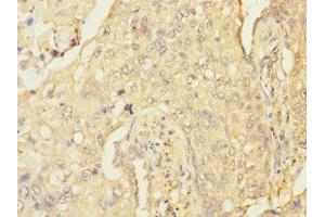 Immunohistochemistry of paraffin-embedded human lung cancer using ABIN7167625 at dilution of 1:100 (RGS anticorps  (AA 230-350))