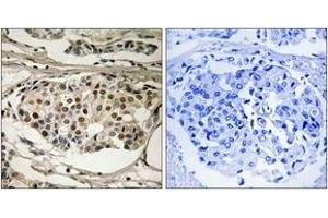 Immunohistochemistry analysis of paraffin-embedded human breast carcinoma, using NF-kappaB p65 (Phospho-Ser281) Antibody. (NF-kB p65 anticorps  (pSer281))