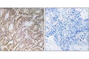 Immunohistochemistry analysis of paraffin-embedded human colon carcinoma tissue, using UBQLN4 Antibody. (UBQLN4 anticorps  (AA 201-250))