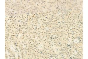 ABIN6260075 and ABIN6272255 at 1/100 staining human pituitary adenoma by IHC-P. (ASF1B anticorps  (Internal Region))