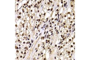 Immunohistochemistry of paraffin-embedded human kidney cancer using HIRIP3 antibody (ABIN2563051) at dilution of 1:100 (40x lens). (HIRIP3 anticorps)