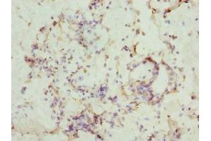 Immunohistochemistry of paraffin-embedded human breast cancer using ABIN7146874 at dilution of 1:100