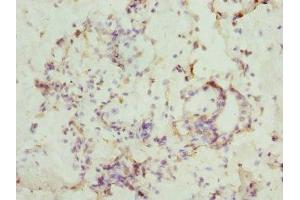 Immunohistochemistry of paraffin-embedded human breast cancer using ABIN7146874 at dilution of 1:100 (CSNK1G1 anticorps  (Isoform gamma 1))