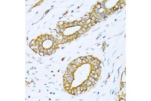 Immunohistochemistry of paraffin-embedded human breast cancer using VARS antibody (ABIN1683239, ABIN3018665, ABIN3018666 and ABIN6220533) at dilution of 1:100 (40x lens).