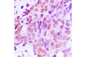 Immunohistochemical analysis of XRCC1 staining in human breast cancer formalin fixed paraffin embedded tissue section.