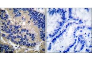 Immunohistochemistry analysis of paraffin-embedded human lung carcinoma tissue, using Caspase 3 (Cleaved-Asp175) Antibody.