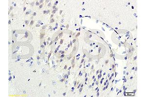 Formalin-fixed and paraffin-embedded human colon carcinoma labeled with Rabbit Anti-GRB2/ASH Polyclonal Antibody (ABIN686932) , Unconjugated 1:200 followed by conjugation to the secondary antibody and DAB staining (GRB2 anticorps)