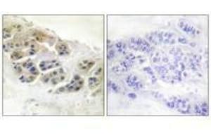 Immunohistochemistry analysis of paraffin-embedded human breast carcinoma tissue using Mammaglobin antibody. (Mammaglobin A anticorps)