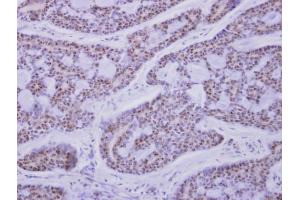 IHC-P Image CaMK1D antibody detects CAMK1D protein at nucleus on human breast cancer by immunohistochemical analysis. (CAMK1D anticorps)
