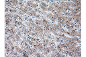 Immunohistochemical staining of paraffin-embedded Carcinoma of liver tissue using anti-SERPINA1mouse monoclonal antibody. (SERPINA1 anticorps)