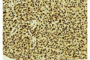 ABIN6274515 at 1/100 staining Human breast cancer tissue by IHC-P.