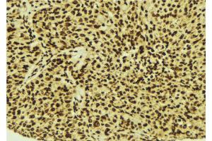 ABIN6274515 at 1/100 staining Human breast cancer tissue by IHC-P. (LASS4 anticorps  (N-Term))