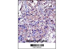MMP11 Antibody immunohistochemistry analysis in formalin fixed and paraffin embedded human breast carcinoma followed by peroxidase conjugation of the secondary antibody and DAB staining. (MMP11 anticorps  (C-Term))