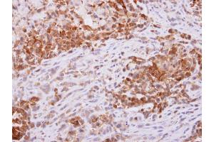 IHC-P Image PGD antibody [N1N3] detects PGD protein at cytoplasm on A549 xenograft by immunohistochemical analysis.
