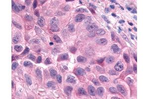 Anti-ESRRA / ERR Alpha antibody IHC of human Lung, Non-Small Cell Carcinoma. (ESRRA anticorps  (Internal Region))