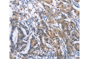 Immunohistochemistry of Human colon cancer using SYT17 Polyclonal Antibody at dilution of 1:60 (SYT17 anticorps)