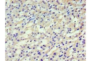 Immunohistochemistry of paraffin-embedded human liver cancer using ABIN7155257 at dilution of 1:100