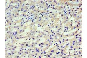 Immunohistochemistry of paraffin-embedded human liver cancer using ABIN7155257 at dilution of 1:100 (HARS1/Jo-1 anticorps  (AA 1-180))