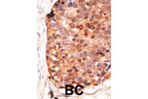 Formalin-fixed and paraffin-embedded human cancer tissue reacted with the APOBEC3G polyclonal antibody  , which was peroxidase-conjugated to the secondary antibody, followed by DAB staining. (APOBEC3G anticorps  (C-Term))