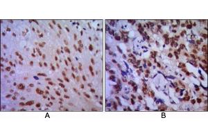 Immunohistochemical analysis of paraffin-embedded human lung cancer (A) and esophageal cancer (B), showing cytoplasmic localization using CDC2 mouse mAb with DAB staining.